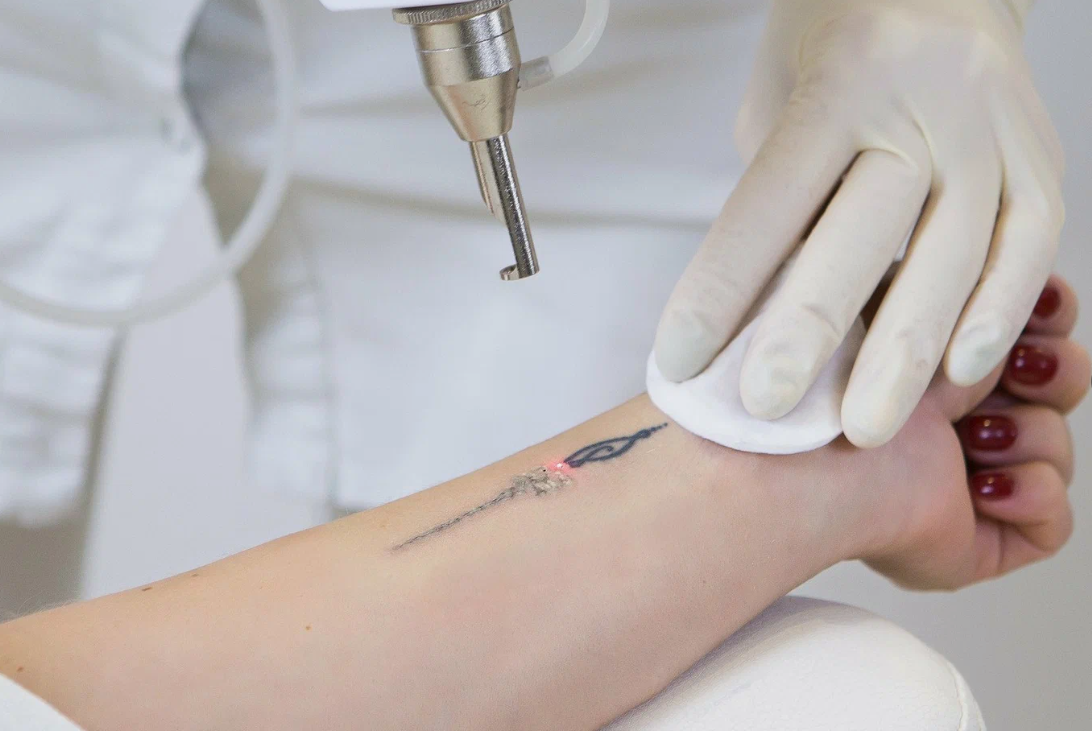 Experience the Latest in Laser Tattoo Removal