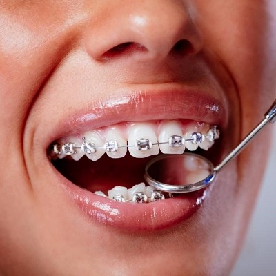 What Is the Ideal Age to See an Orthodontist?