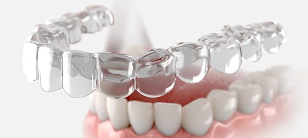 Aligners for Busy Professionals: Why They're the Best Choice for Your Schedule