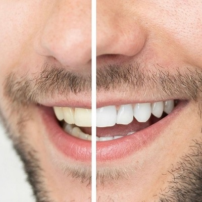 How Often Should You Get Your Teeth Whitened?