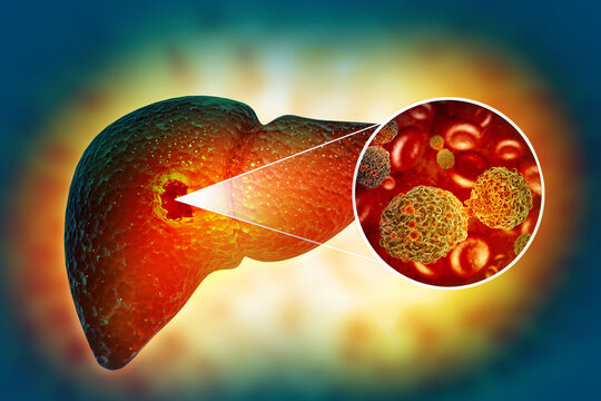 Alcoholic Hepatitis Treatment Market Trends and Dynamics 2022-2030