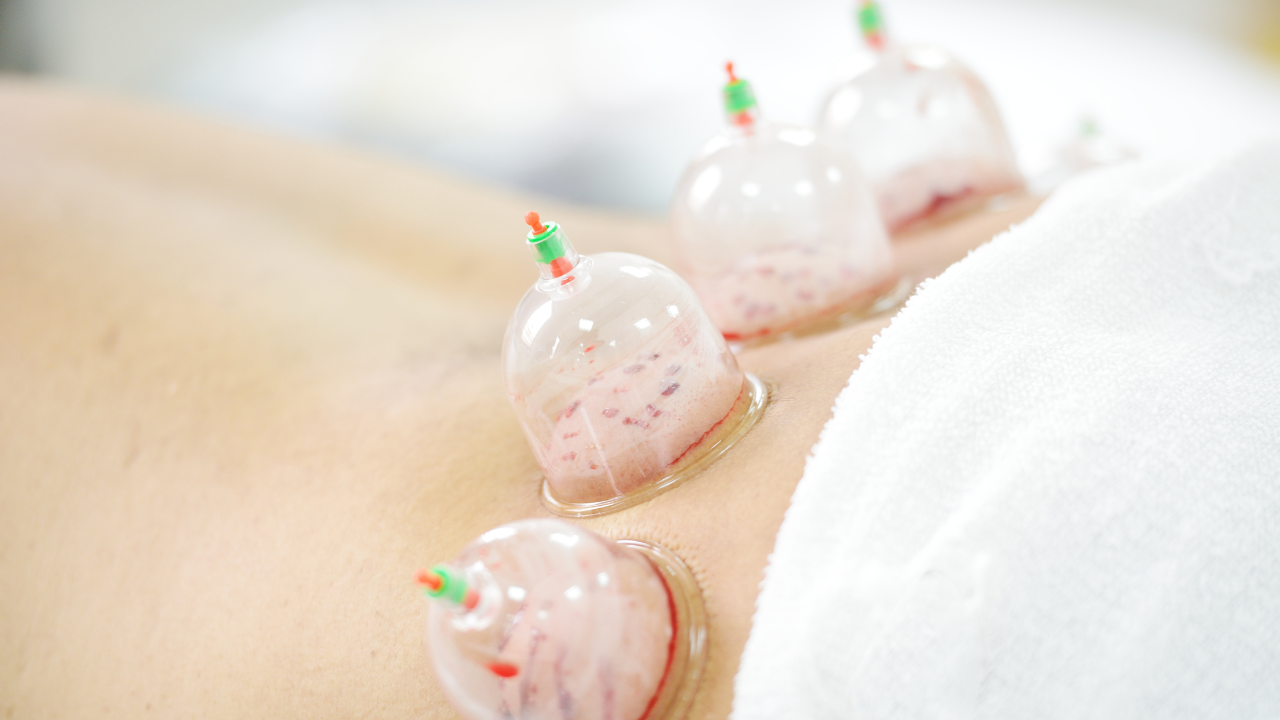 Hijama Cupping Therapy for Stress Relief and Healing