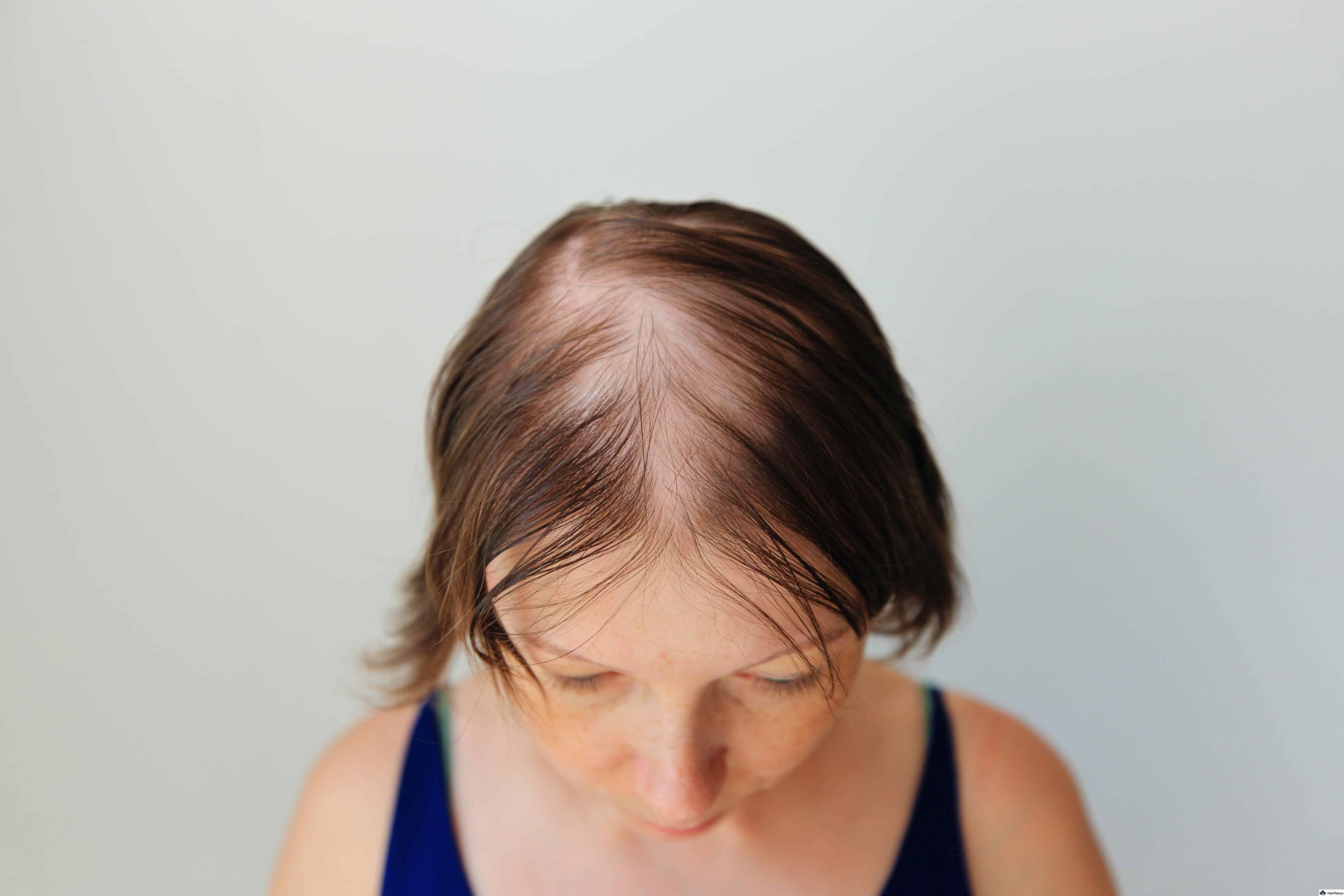 The Future of Hair Restoration: Innovative Techniques in Dubai