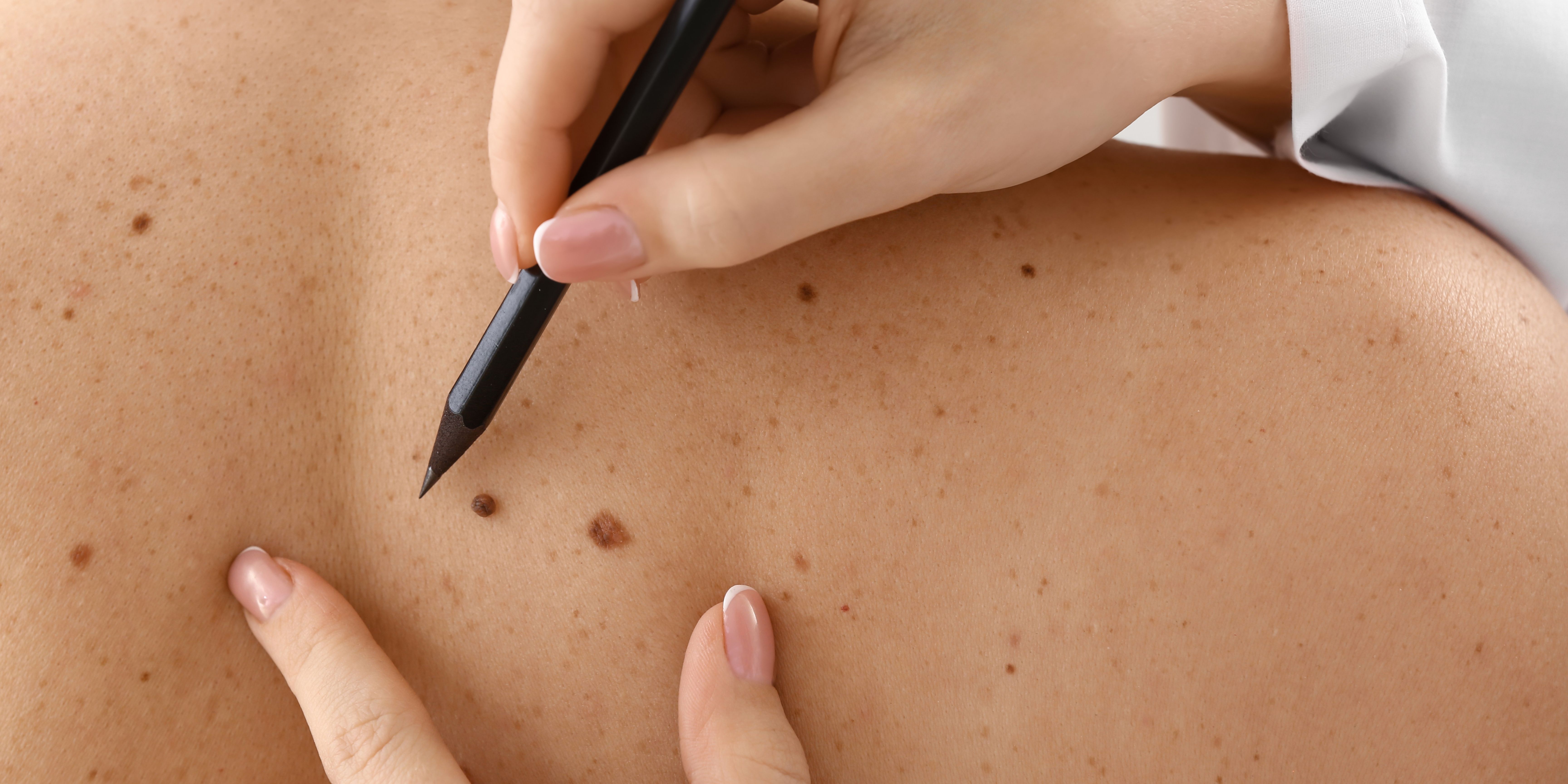 Is Mole Removal Safe for Children?