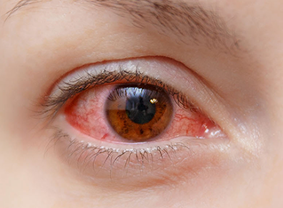 Allergic Conjunctivitis Market Insights on Current Scope 2033