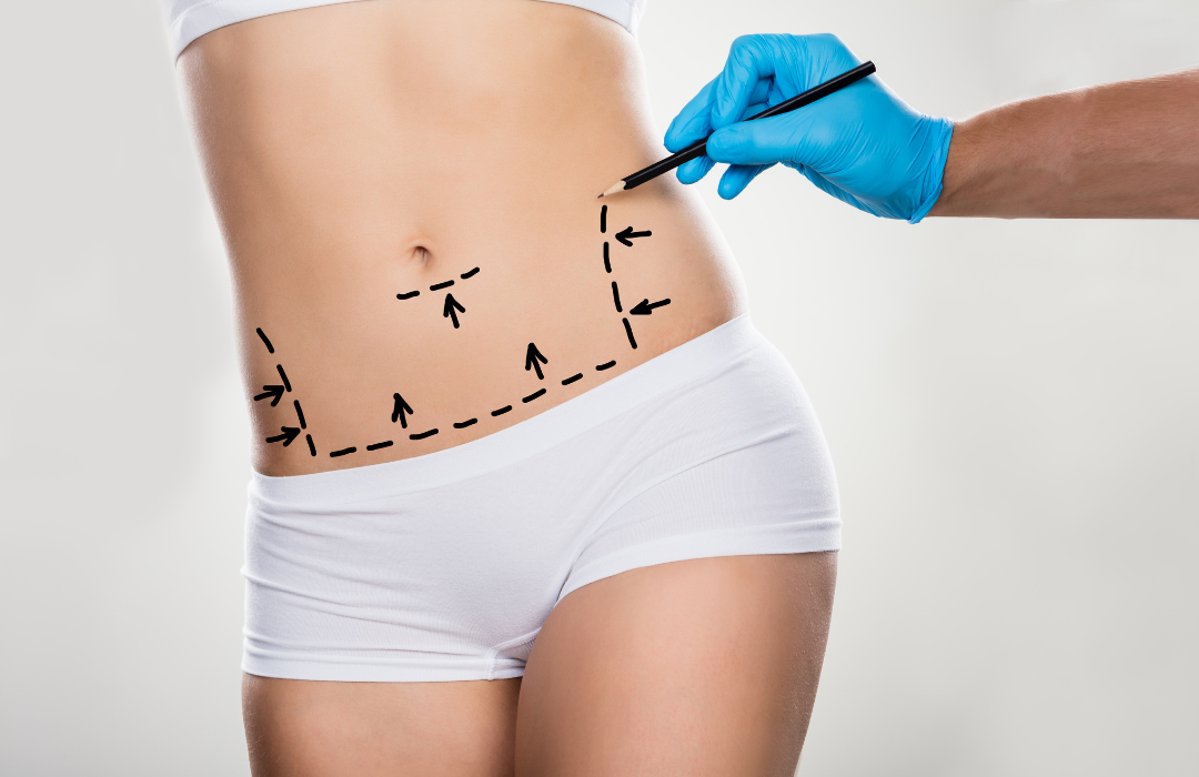 Liposuction Surgery in Dubai: A Rising Trend Among Men