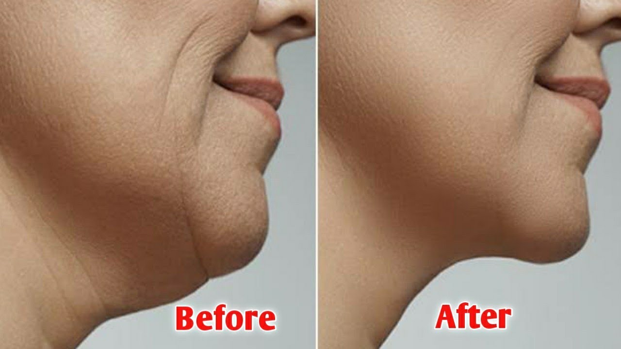 Achieve a Defined Jawline with Double Chin Removal in Riyadh