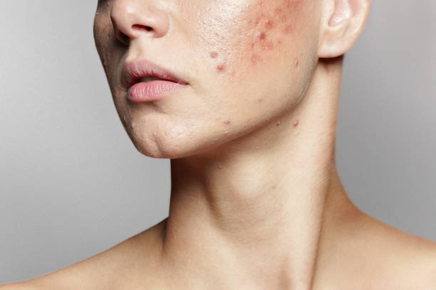 Acne Treatment: Red Light and Blue Light Therapy – The New Standard in Acne Care