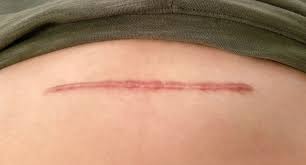 Clear, Beautiful Skin Awaits with Keloid Treatment in Dubai