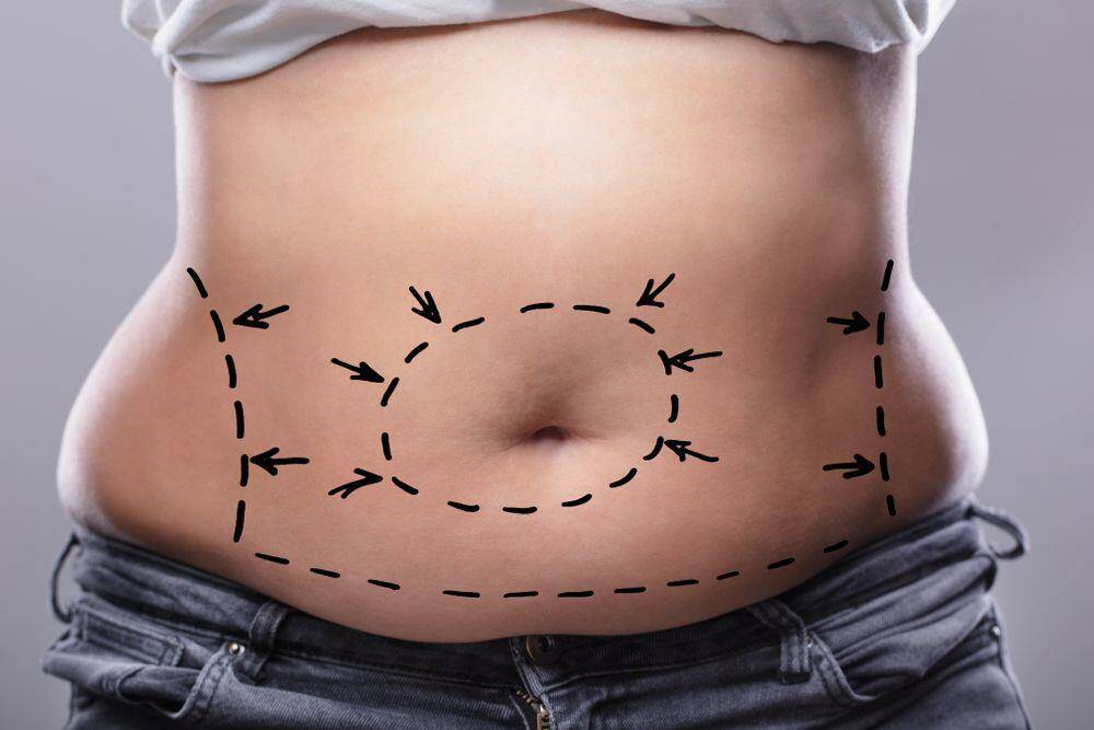 How Do You Ensure a Hassle-Free Liposuction Recovery in Dubai?