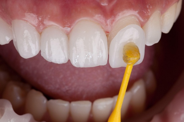 Răng mẻ có trám được không? Giải đáp từ chuyên gia
