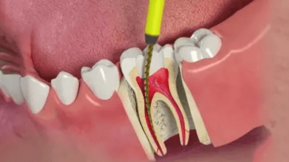 Quy trình trám răng lấy tủy: Giải pháp chăm sóc răng miệng toàn diện