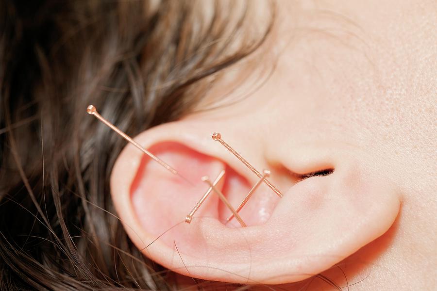 How Ear Acupuncture Points Influence Holistic Healing