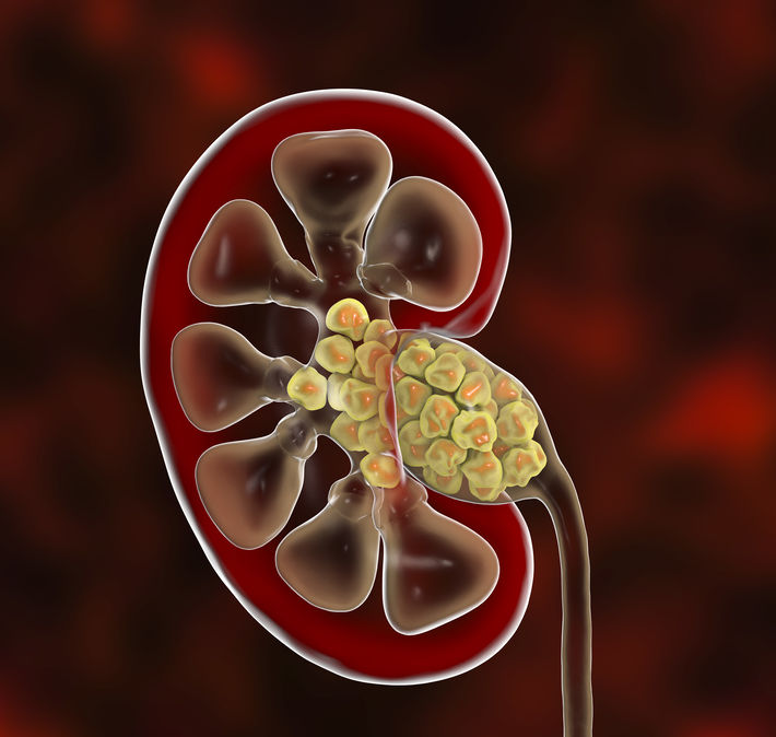 The Recovery Process for Kidney Stone Removal Treatment in Dubai