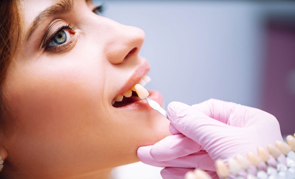 The Ultimate FAQ for Dental Veneers Seekers