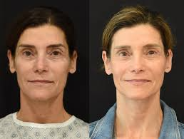 Best 7 Neck Lift Surgeons in San Diego
