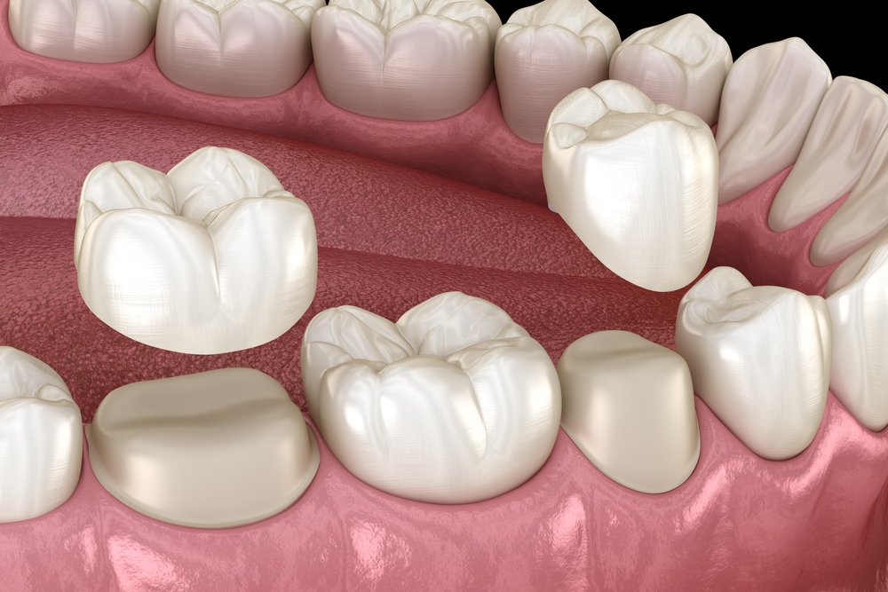Dental Crowns in San Antonio, TX - Mysa Dental