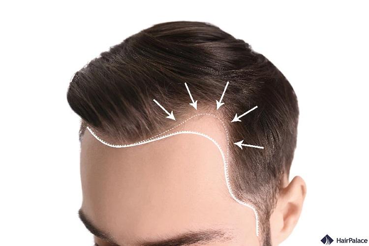 A Guide to Front Line Hair Fixing Options Available in Dubai