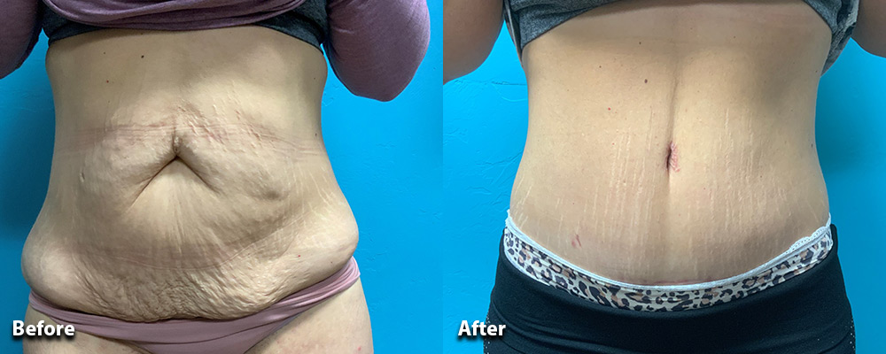 Top 5 Best Lip Augmentation Clinics in West Palm Beach for Beautiful, Fuller Lips