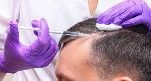 Understanding PRP Therapy and Its Mechanism : PRP Hair Treatment in Dubai