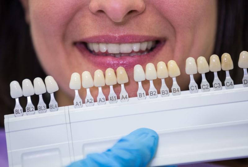 Achieve a Hollywood Smile with Modern Dental Veneers