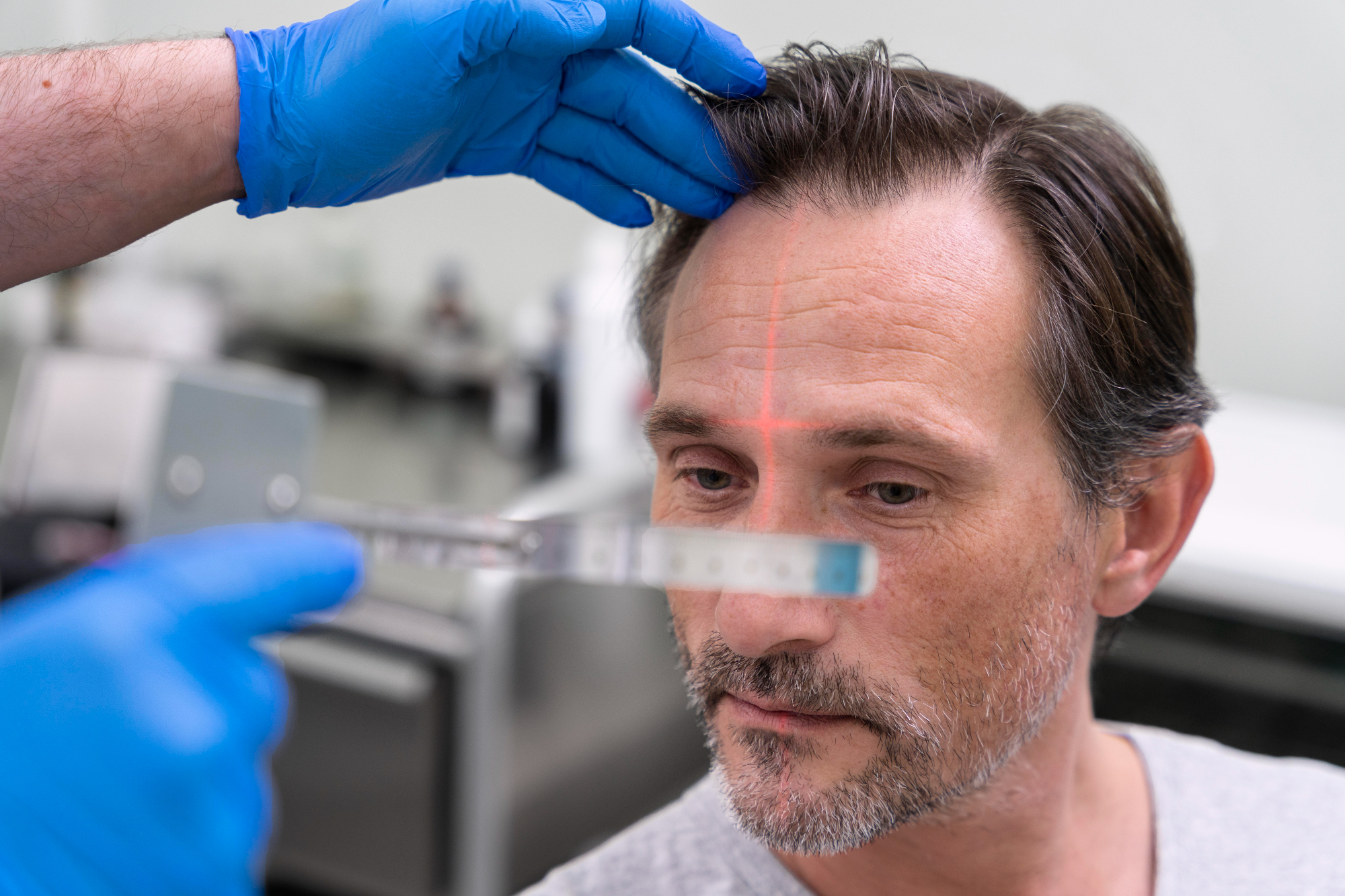 Are Hair Transplants Painful or Comfortable?