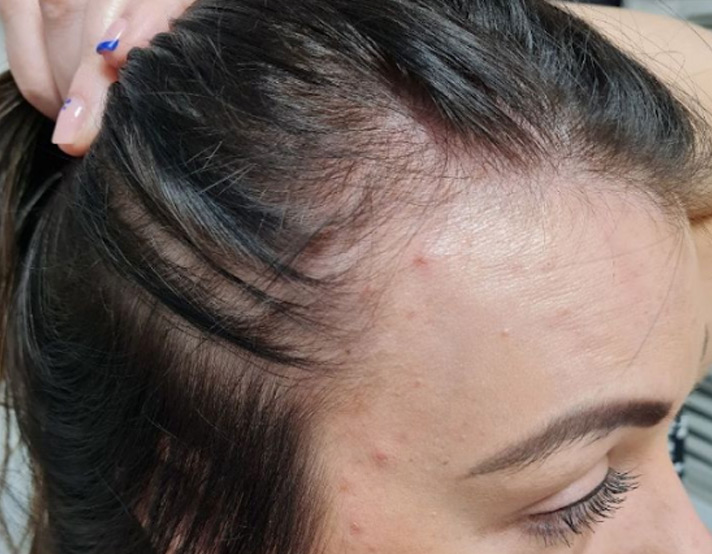 What Are the Risks of Getting a Hair Transplant in Dubai?