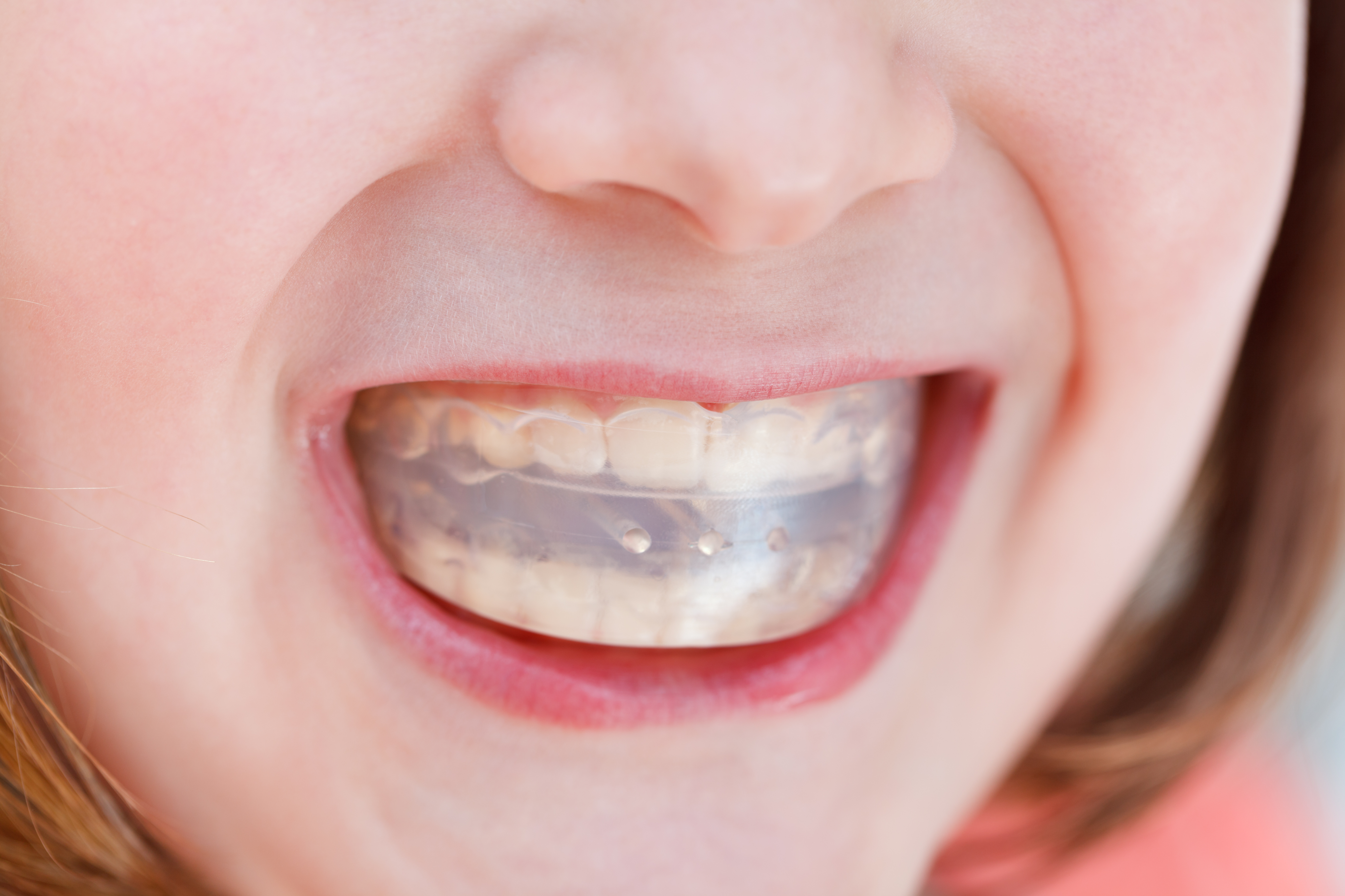 Protecting Your Smile: How Mouthguards Prevent Long-Term Dental Damage