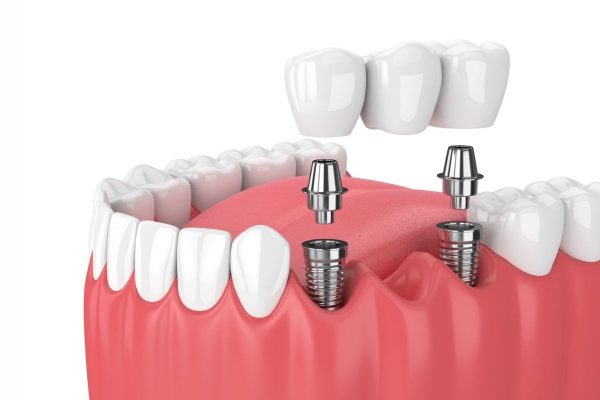 Trồng Implant có đau không? Giải đáp từ Nha khoa Sing