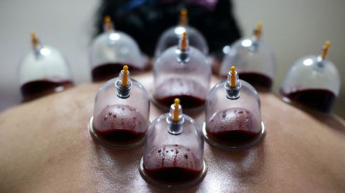 How Hijama Cupping Enhances Mental and Physical Well-being