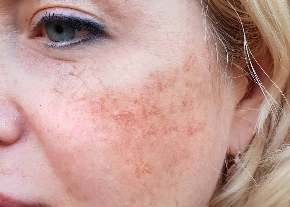 Affordable Melasma Treatment Options in Islamabad