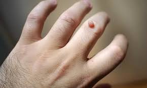 When Should You Opt for Cryotherapy for Skin Wart Removal in Dubai?