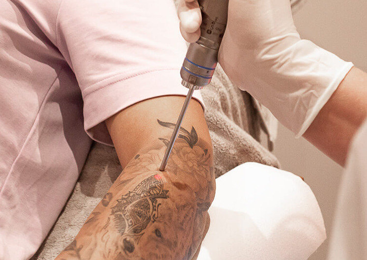 Picosure Tattoo Removal Aftercare: Tips for Best Results in Dubai