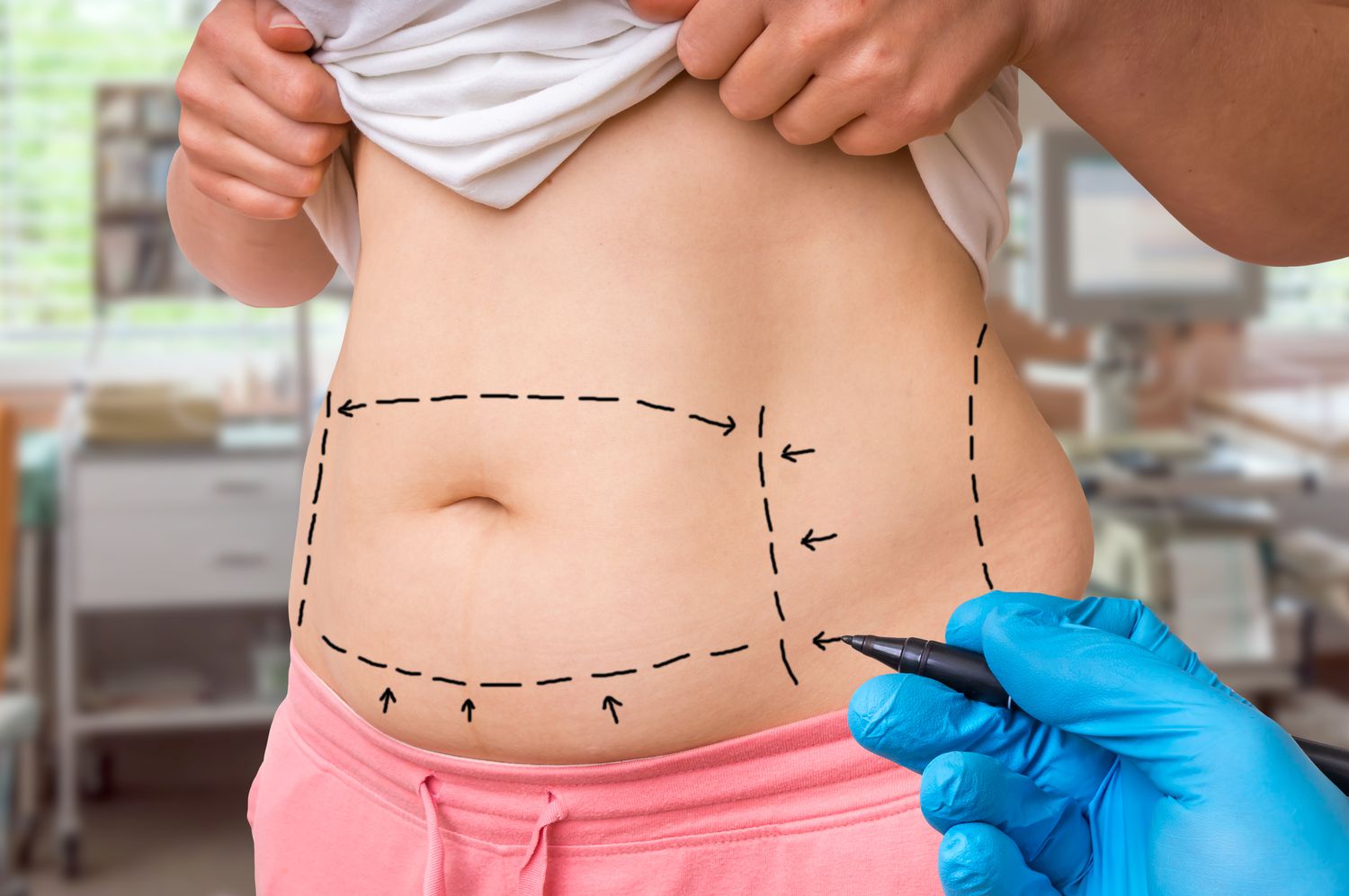 Combining Tummy Tuck and Liposuction in Riyadh
