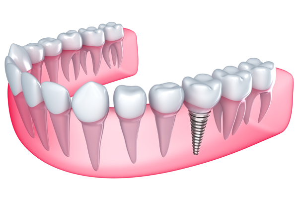 Understanding the Connection Between Dental Implants and Bone Loss
