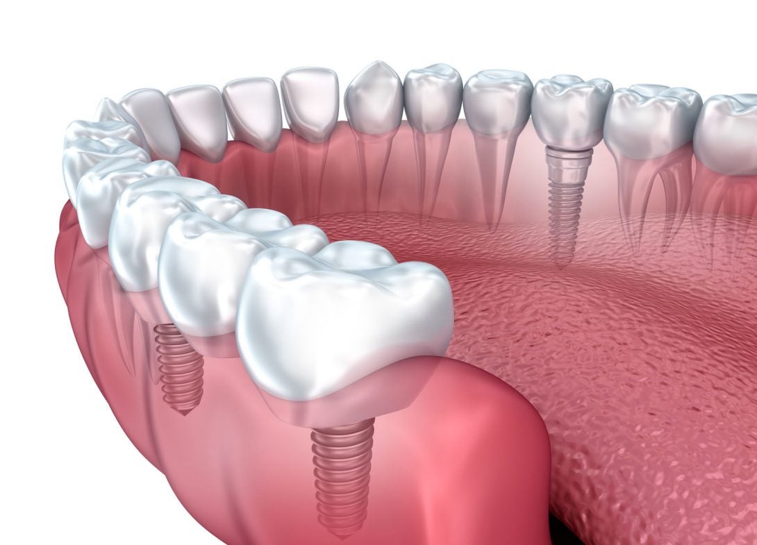 The Long-Term Benefits of Dental Implants Over Traditional Restorations