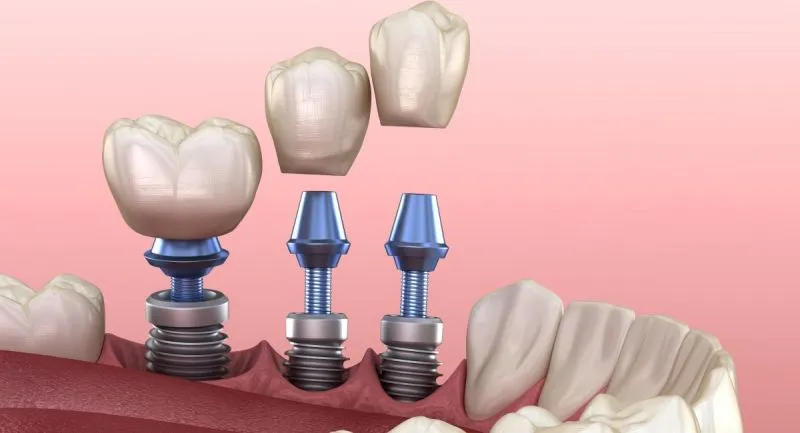 The Science Behind Dental Implants: Why They’re the Best Tooth Replacement