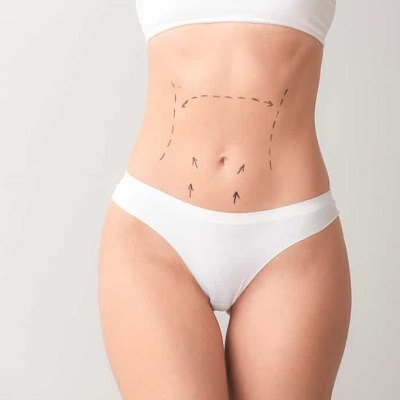 What Are the Benefits of a Tummy Tuck?