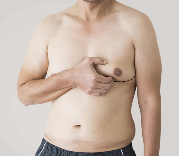 Is Gynecomastia Surgery Right for You?