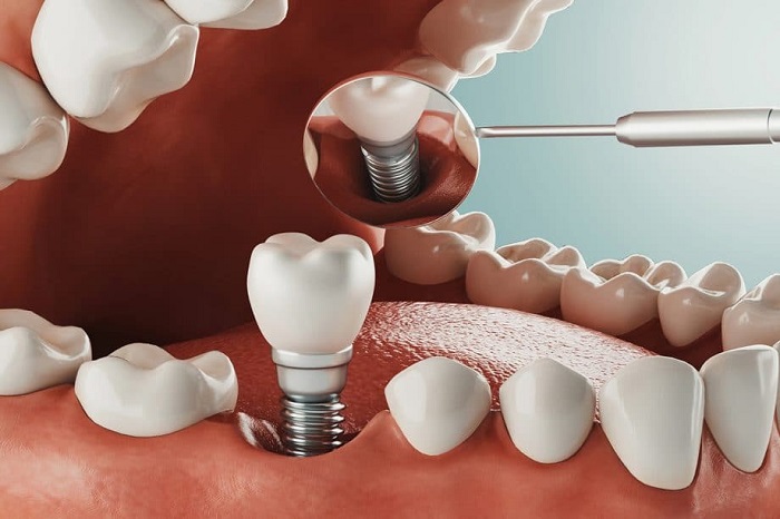 How to Save Money When Buying Dental Screws