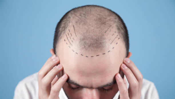 Who Are the Most Experienced Hair Replacement Specialists in Dubai?