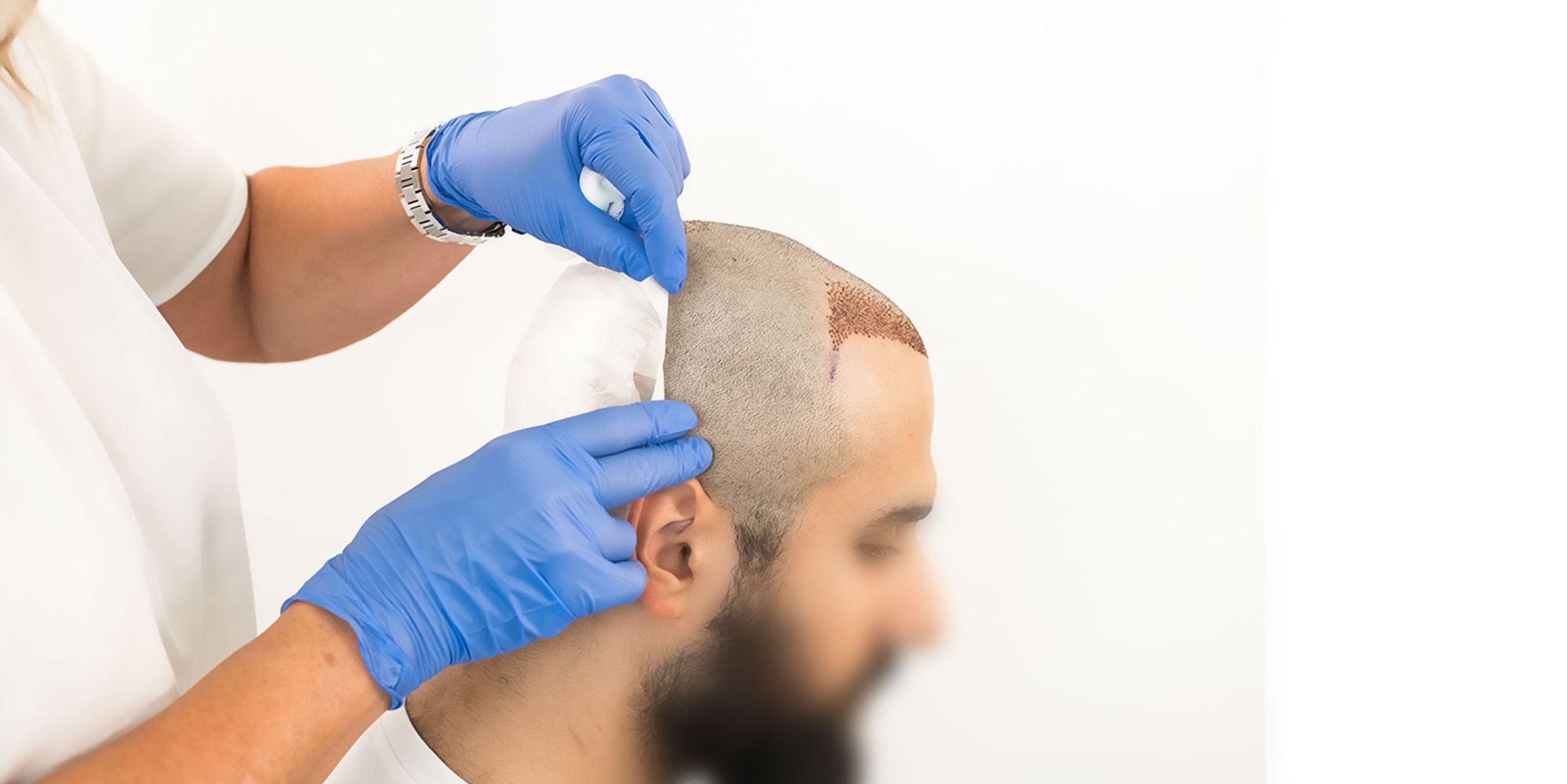 Hair Transplant Cost Guide: Riyadh Edition