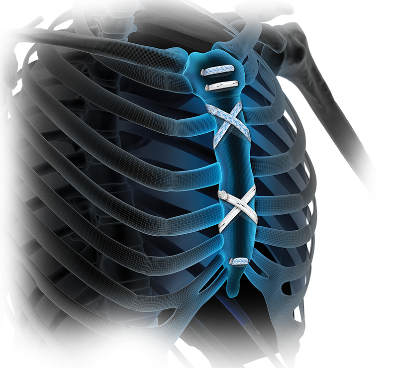 Sternal Closure Systems Market to Showcase Robust Growth By Forecast to 2033
