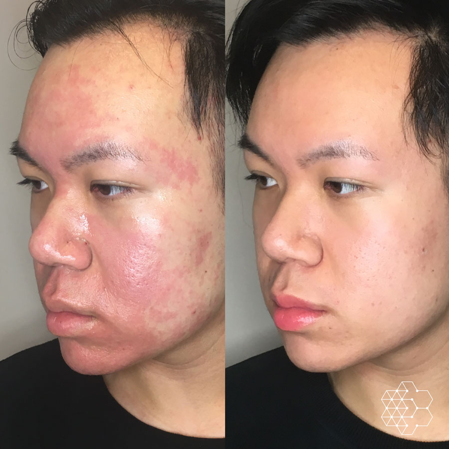 The Role of PRP in Acne Scar Treatment in Dubai