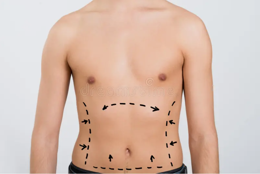 Success Stories from VASER Liposuction Patients in Riyadh