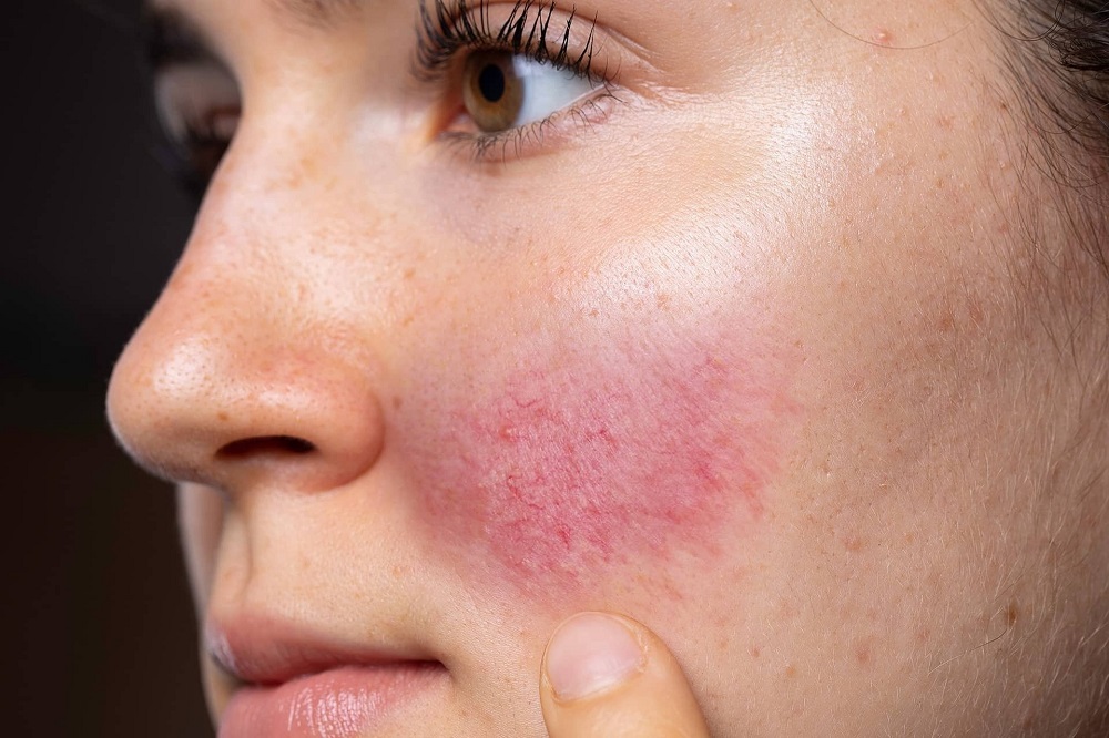 Where to Find the Best Rosacea Treatment Clinics in Islamabad