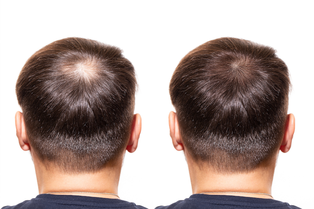 Platelet Rich Plasma Hair Treatment in Dubai: Is It Worth the Investment
