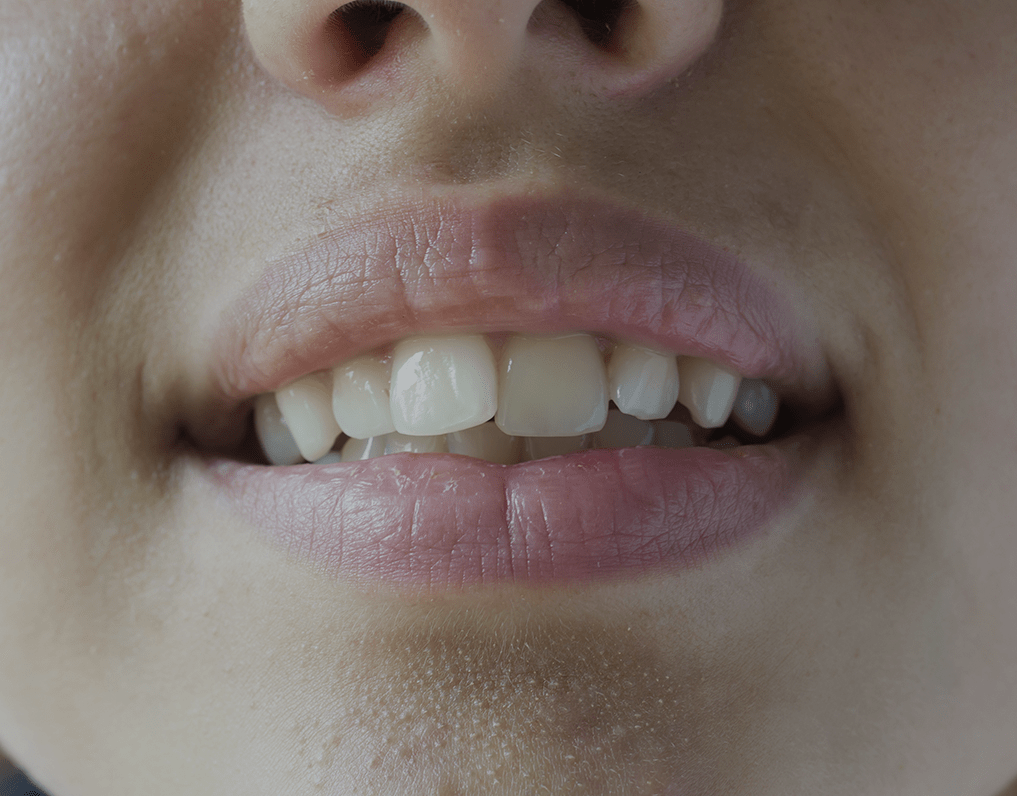 Everything You Need to Know About Treating Overlapping Teeth