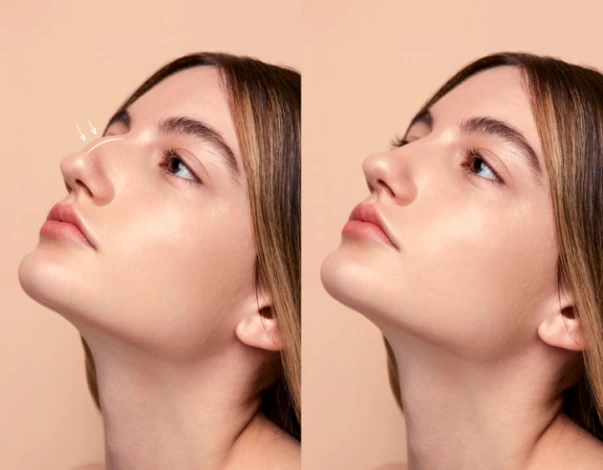 Minimally Invasive Rhinoplasty Options in Dubai