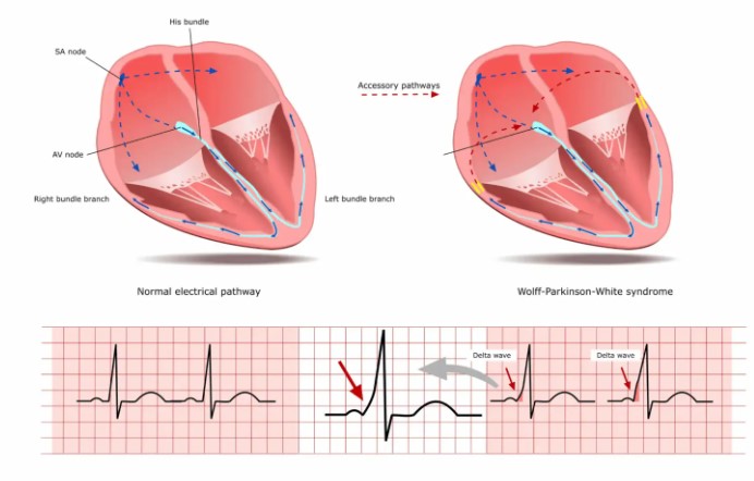 Ablation for Wolff Parkinson White in UAE: The Best Solution for a Healthier Heart